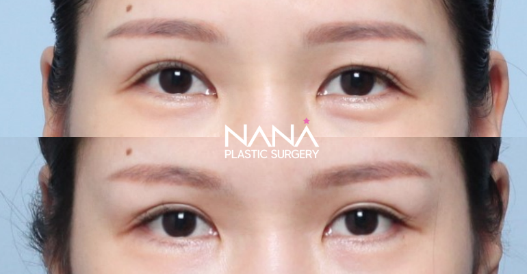 Eyes Before & After — Before & After