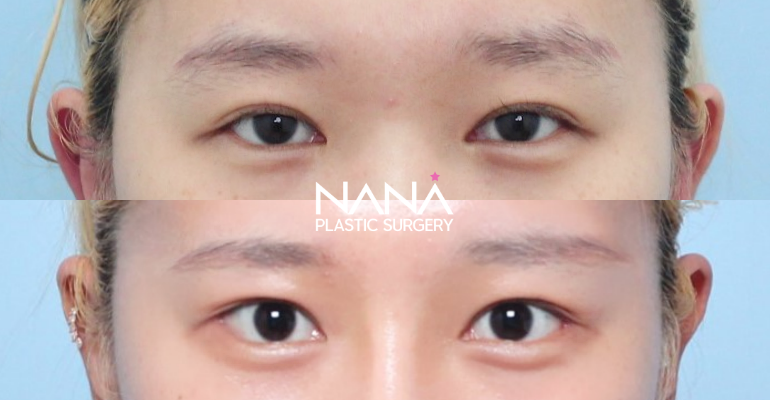 Eyes Before & After — Before & After