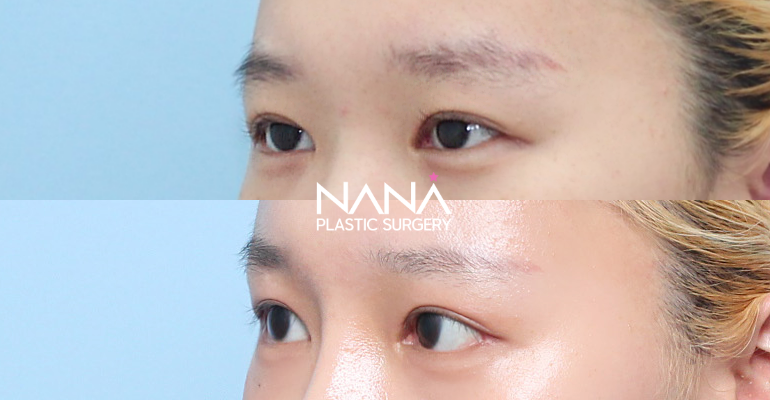 Before & After Before & After
