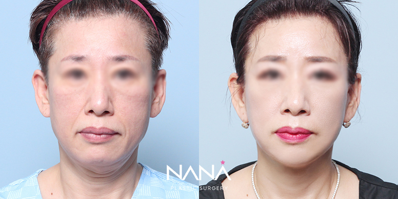 リフティング 症例写真 — 症例写真