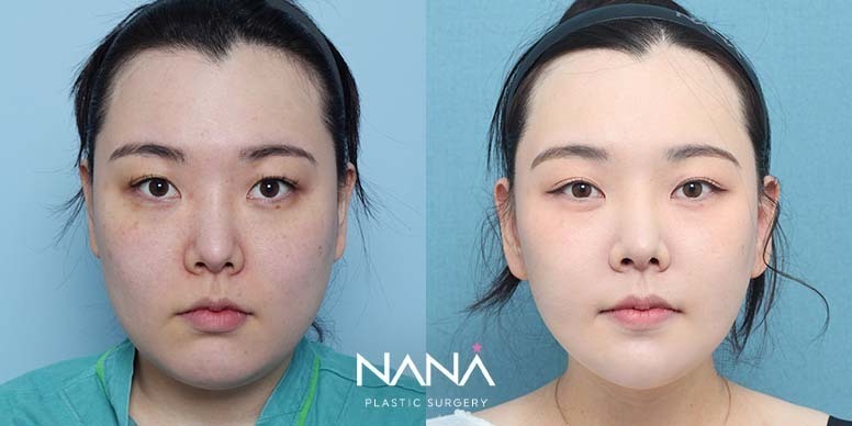 Before & After Before & After