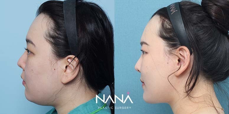 Before & After Before & After