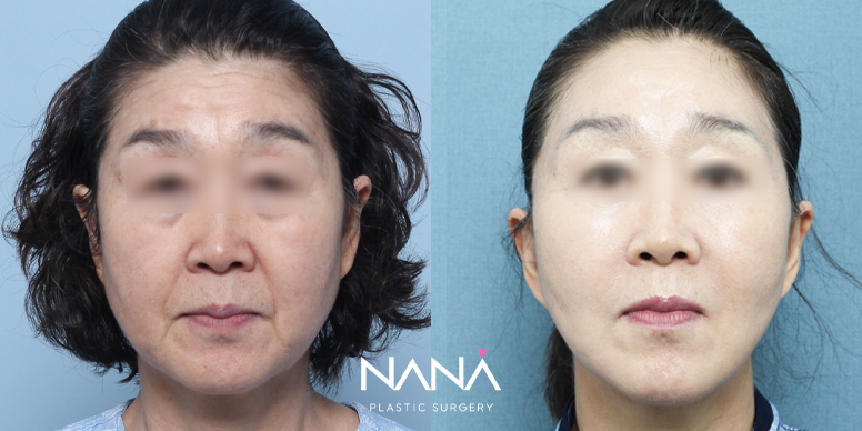 Lifting Before & After — Before & After