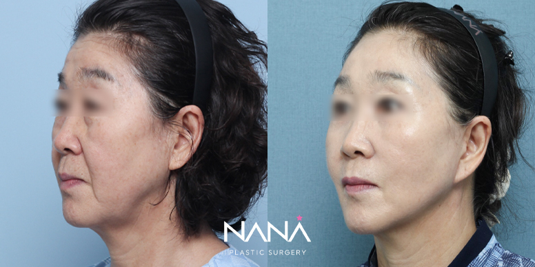Before & After Before & After