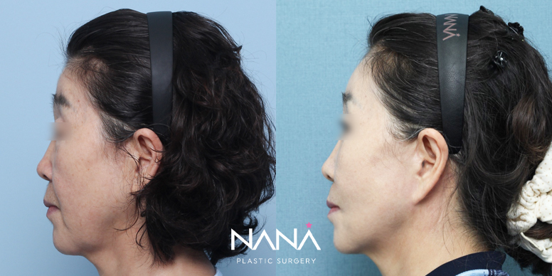 Before & After Before & After