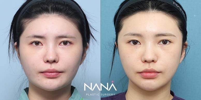 Before & After Before & After