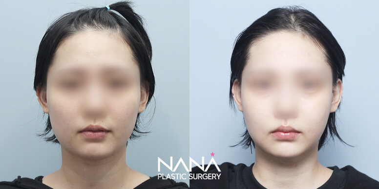 Facial Contouring Before & After — Before & After