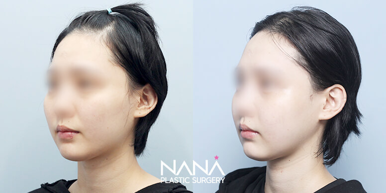 Before & After Before & After
