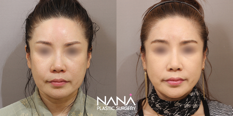 Lifting Before & After — Before & After