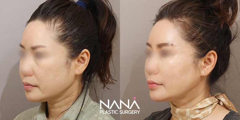 Before & After Before & After