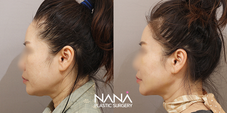 Before & After Before & After