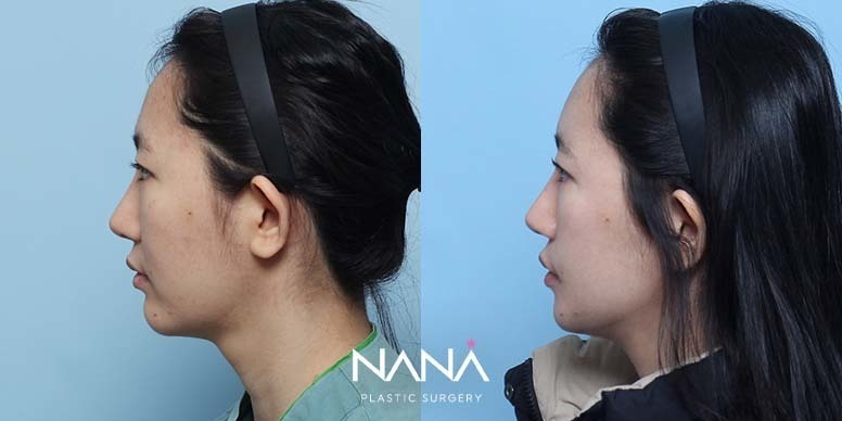 Before & After Before & After