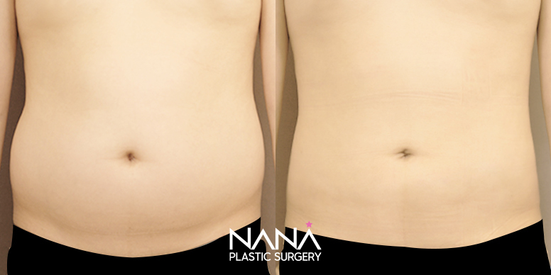 Liposuction Before & After — Before & After