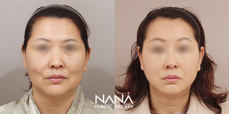 Lifting Before & After — Before & After