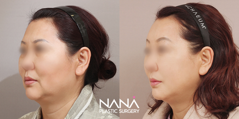 Before & After Before & After