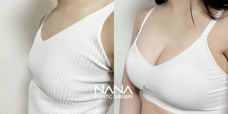 전후사진 전후사진