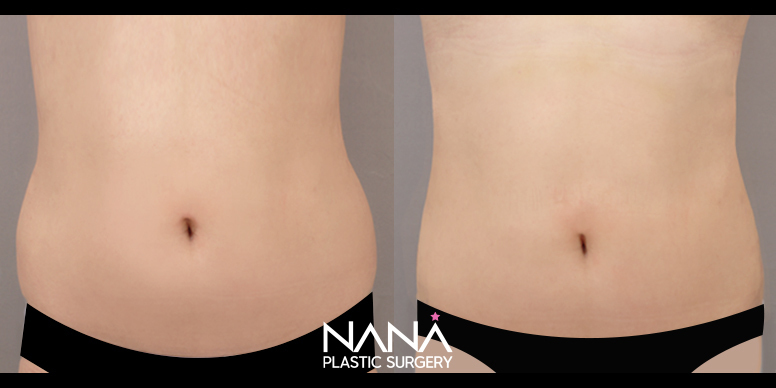 Liposuction Before & After — Before & After