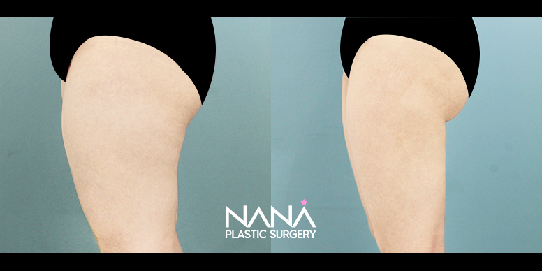 Liposuction Before & After — Before & After