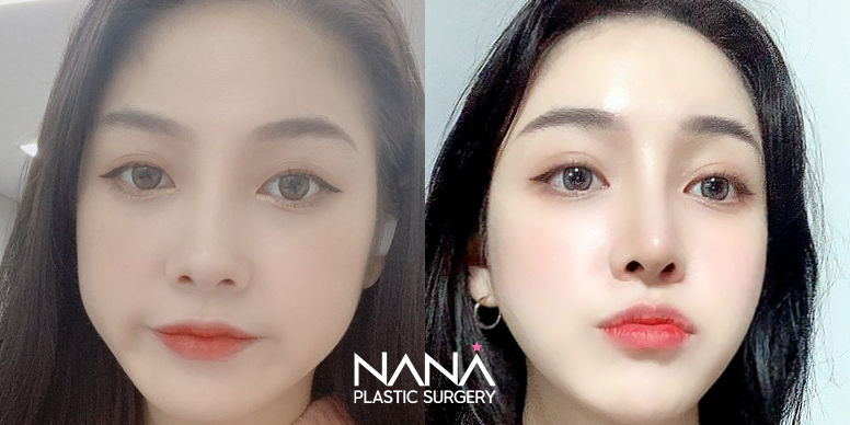 Before & After Before & After