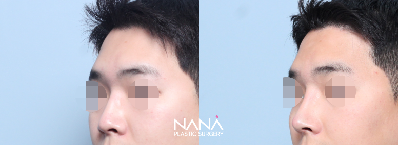 男性整形 症例写真 — 症例写真