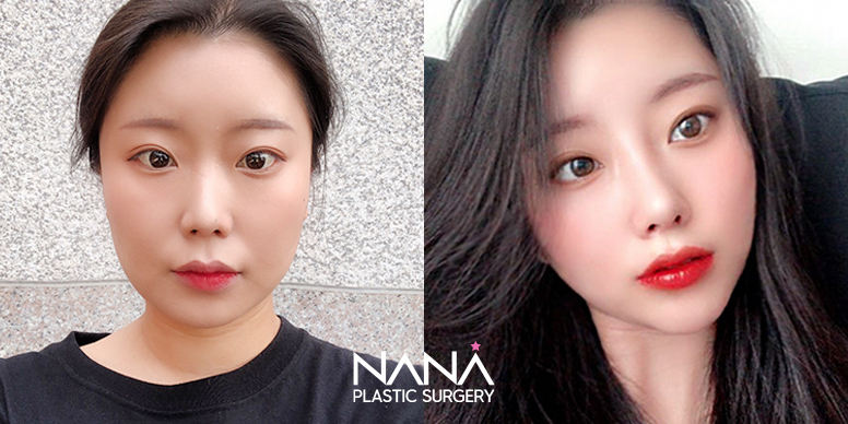 Liposuction Before & After — Before & After