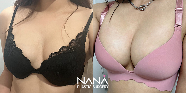 전후사진 전후사진
