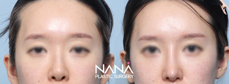 Before & After Before & After