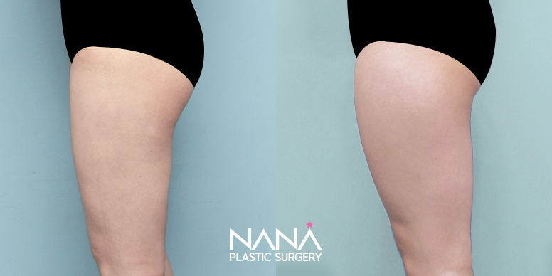 Liposuction Before & After — Before & After