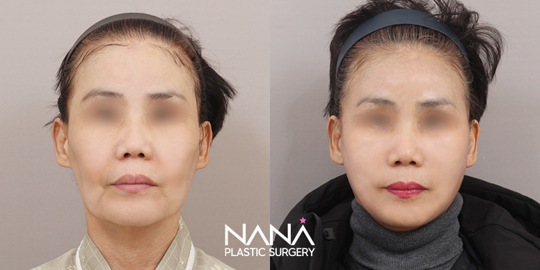Before & After Before & After