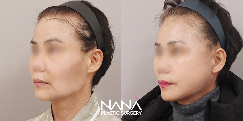 Before & After Before & After