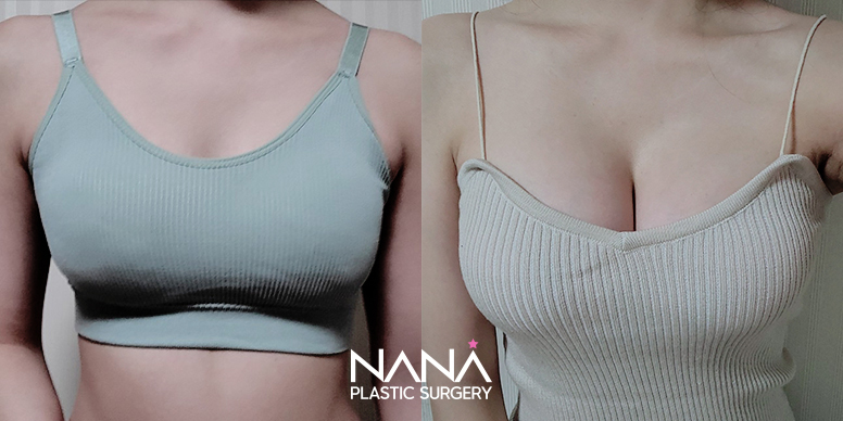 Breast Before & After — Before & After