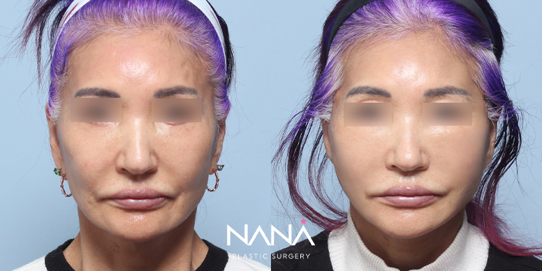 Lifting Before & After — Before & After