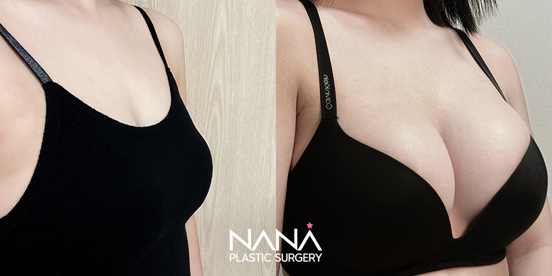 Breast Before & After — Before & After