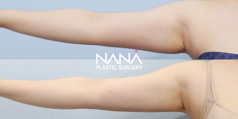 Liposuction Before & After — Before & After