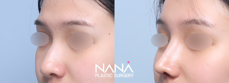 Nose Before & After — Before & After