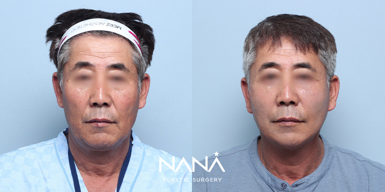 リフティング 症例写真 — 症例写真