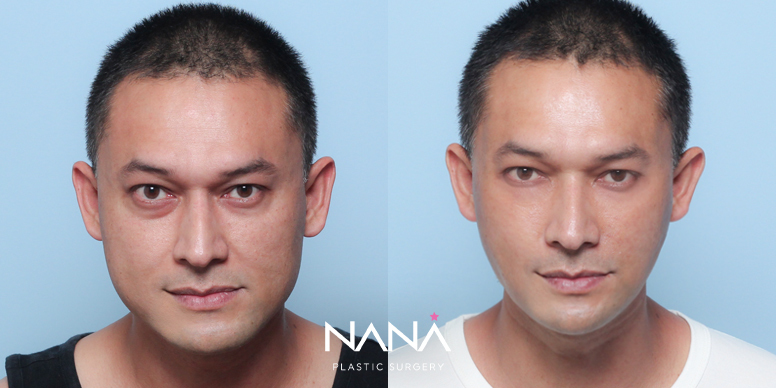 リフティング 症例写真 — 症例写真