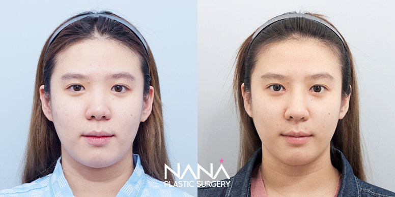 Liposuction Before & After — Before & After