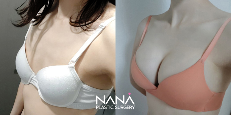 전후사진 전후사진