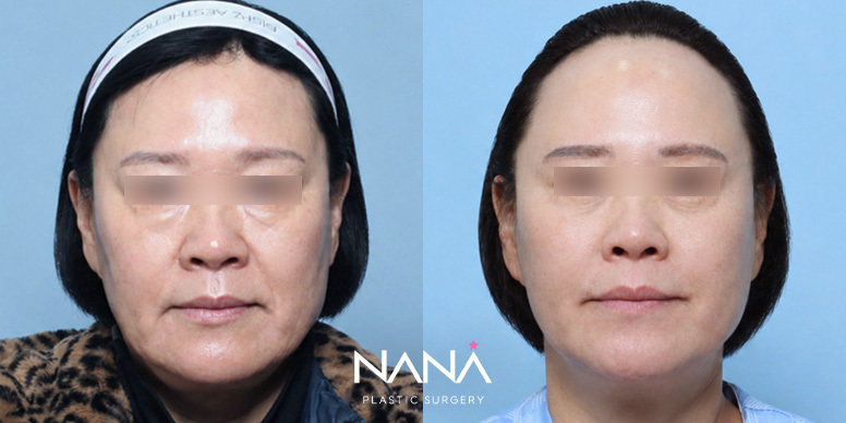Lifting Before & After — Before & After