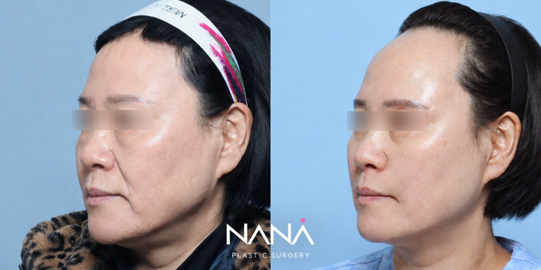 Before & After Before & After