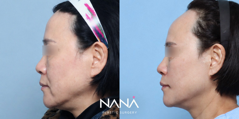 Before & After Before & After