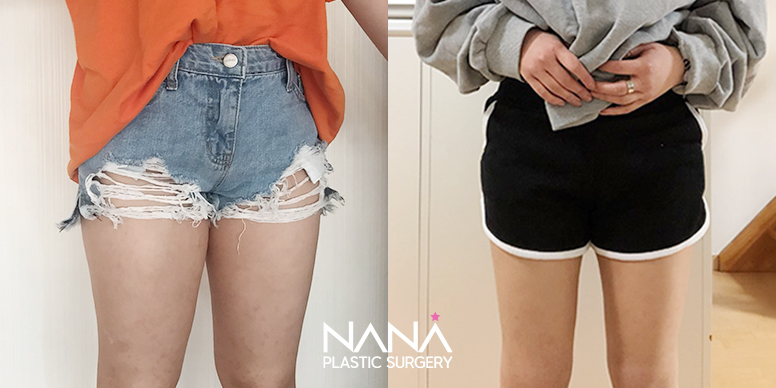 Liposuction Before & After — Before & After