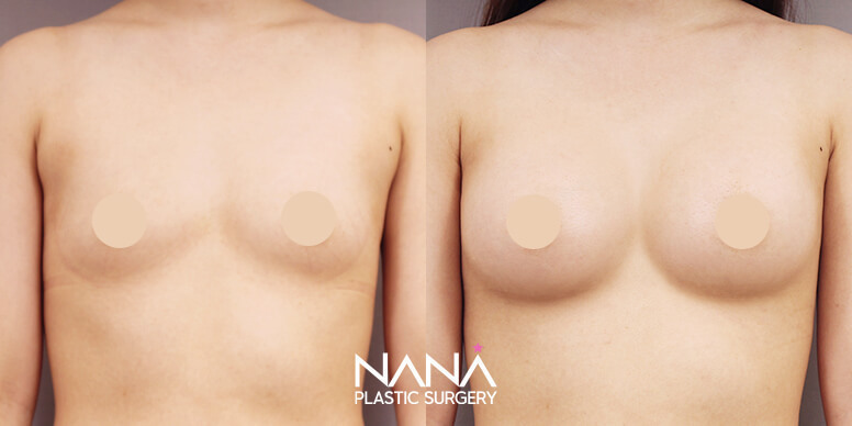 Breast Before & After — Before & After