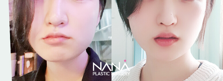 Facial Contouring Before & After — Before & After