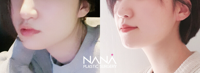 Before & After Before & After