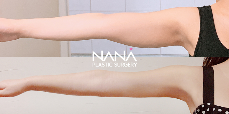 Liposuction Before & After — Before & After
