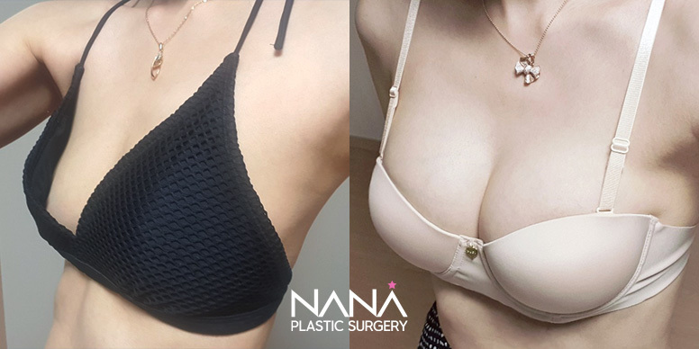 Breast Before & After — Before & After