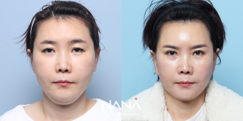 リフティング 症例写真 — 症例写真