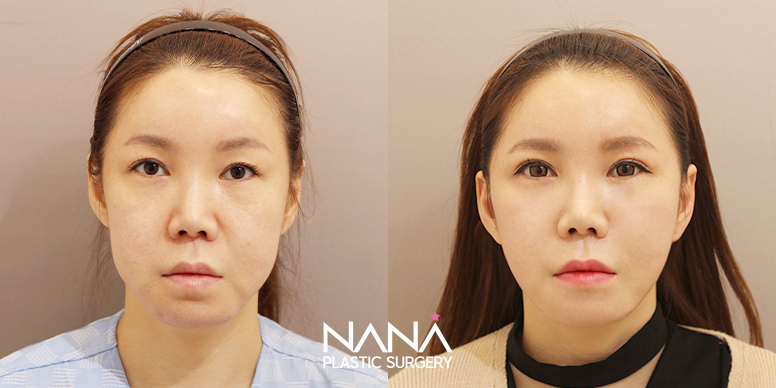 Lifting Before & After — Before & After